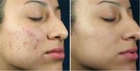 Teen Acne Treatment And Facial image 7